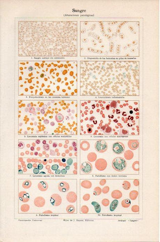 LAMINA V39724: Sangre alteraciones patologicas