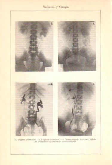 LAMINA V47985: Urografia descendente y ureteropielografia doble