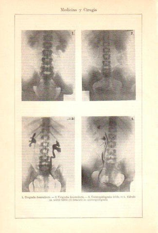 LAMINA V47985: Urografia descendente y ureteropielografia doble