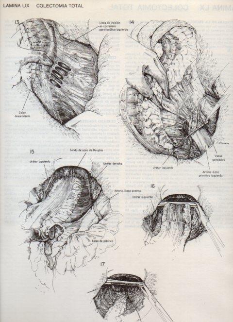 LAMINA V20120: Colectomia total 3