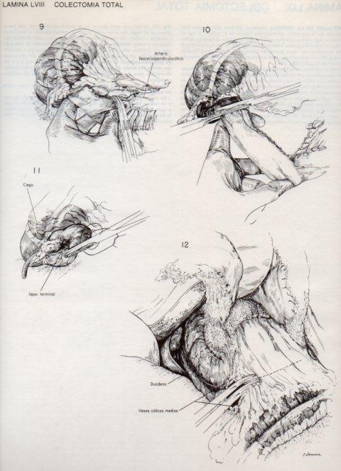 LAMINA V20119: Colectomia total 2