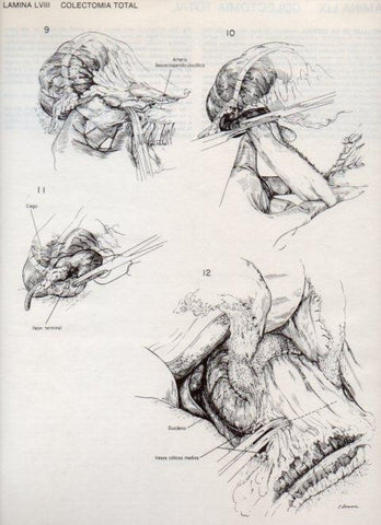 LAMINA V20119: Colectomia total 2