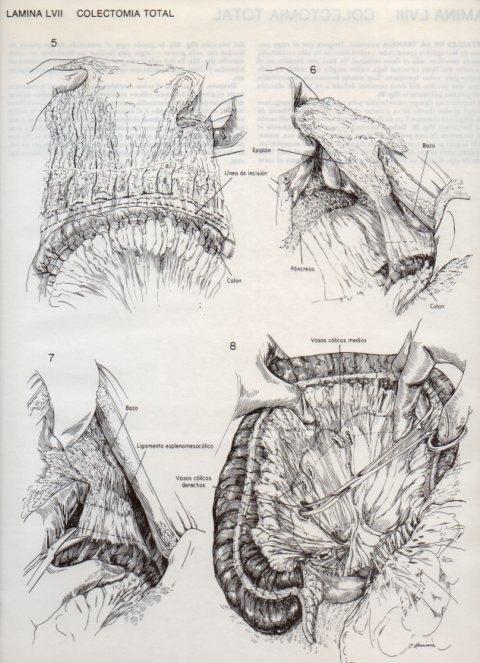 LAMINA V20118: Colectomia total 1
