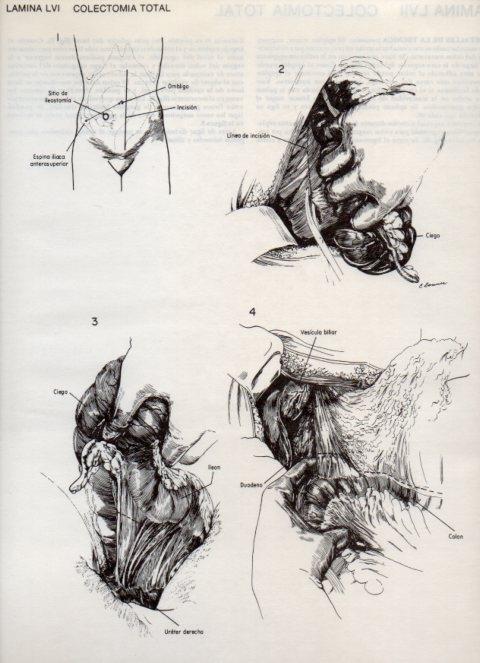 LAMINA V20117: Colectomia total