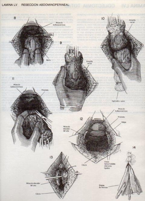 LAMINA V20116: Reseccion abdominoperineal 5