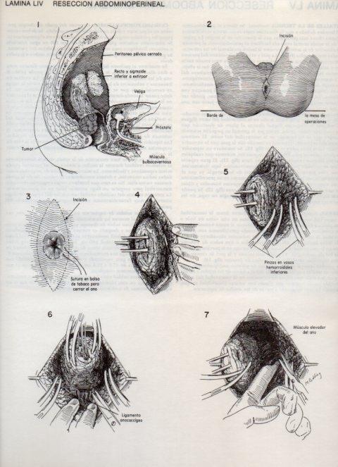 LAMINA V20115: Reseccion abdominoperineal 4