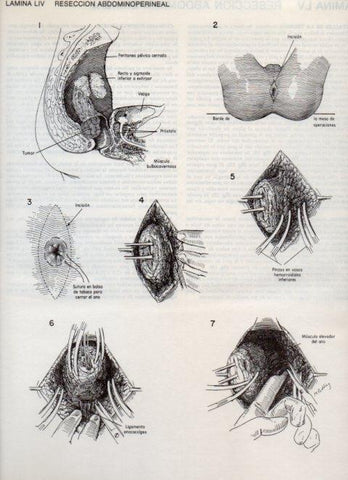 LAMINA V20115: Reseccion abdominoperineal 4