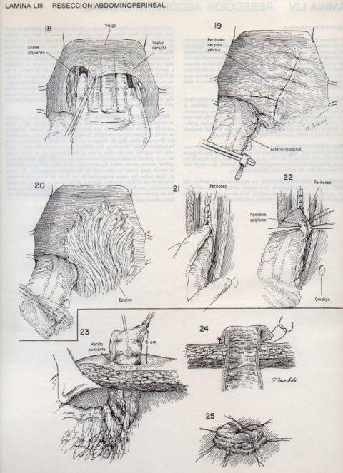 LAMINA V20114: Reseccion abdominoperineal 3