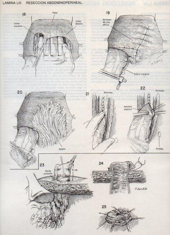LAMINA V20114: Reseccion abdominoperineal 3