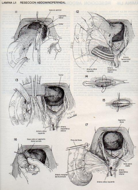 LAMINA V20113: Reseccion abdominoperineal 2