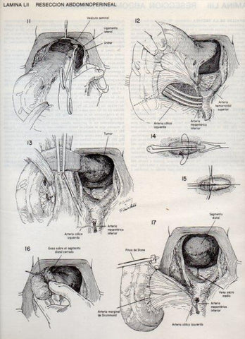 LAMINA V20113: Reseccion abdominoperineal 2