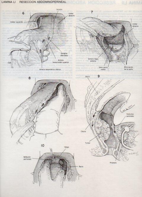 LAMINA V20112: Reseccion abdominoperineal 1