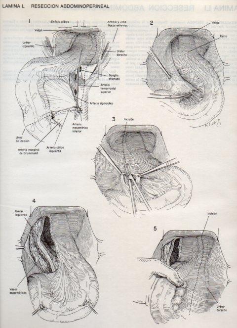 LAMINA V20111: Reseccion abdominoperineal