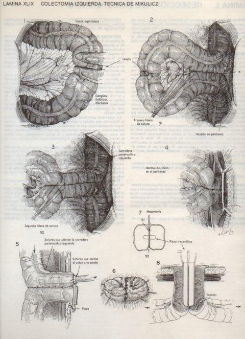 LAMINA V20110: Colectomia izquierda, tecnica de Mikulicz