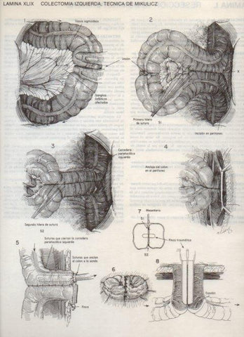 LAMINA V20110: Colectomia izquierda, tecnica de Mikulicz