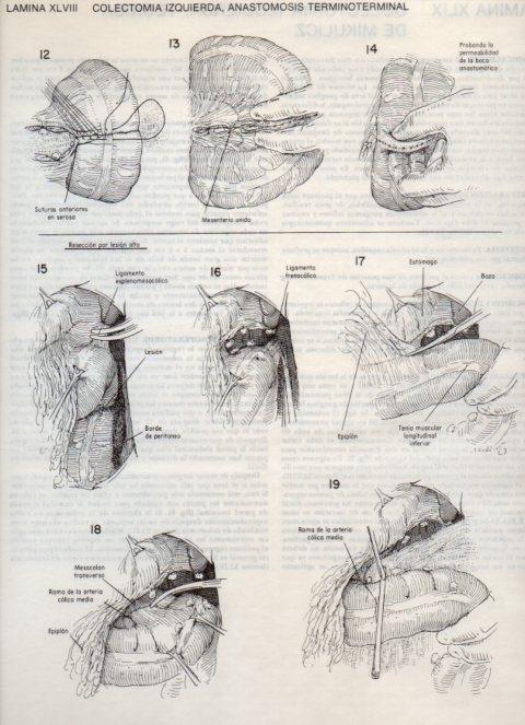 LAMINA V20109: Colectomia izquierda, anastomosis terminoterminal