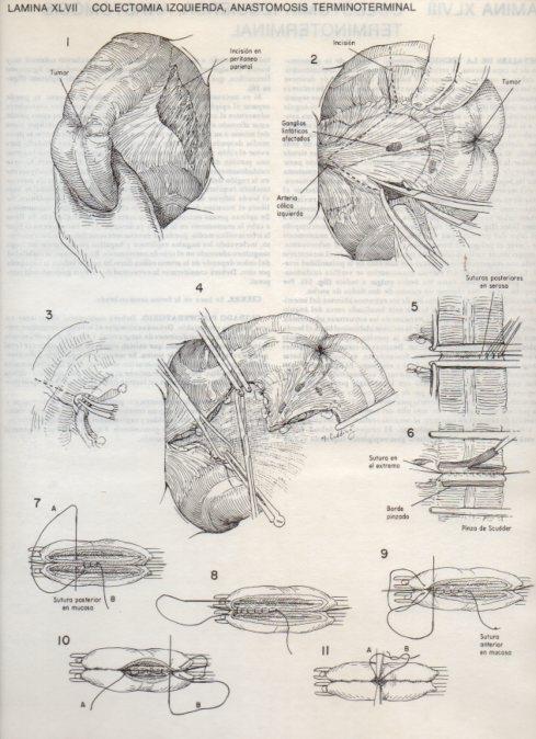 LAMINA V20108: Colectomia izquierda, anastomosis terminoterminal