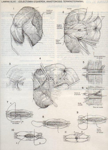 LAMINA V20108: Colectomia izquierda, anastomosis terminoterminal