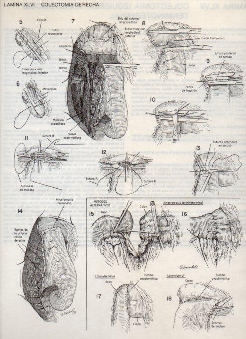 LAMINA V20107: Colectomia derecha 1