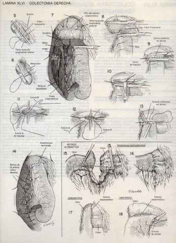 LAMINA V20107: Colectomia derecha 1