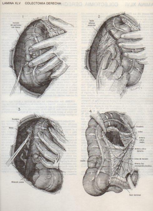 LAMINA V20106: Colectomia derecha