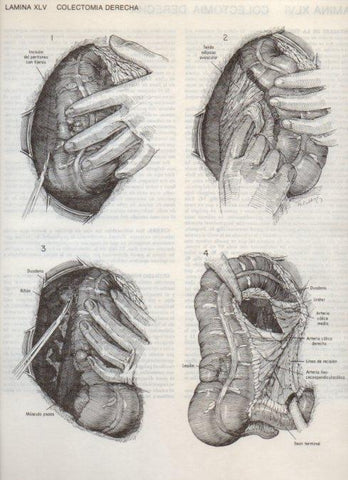 LAMINA V20106: Colectomia derecha