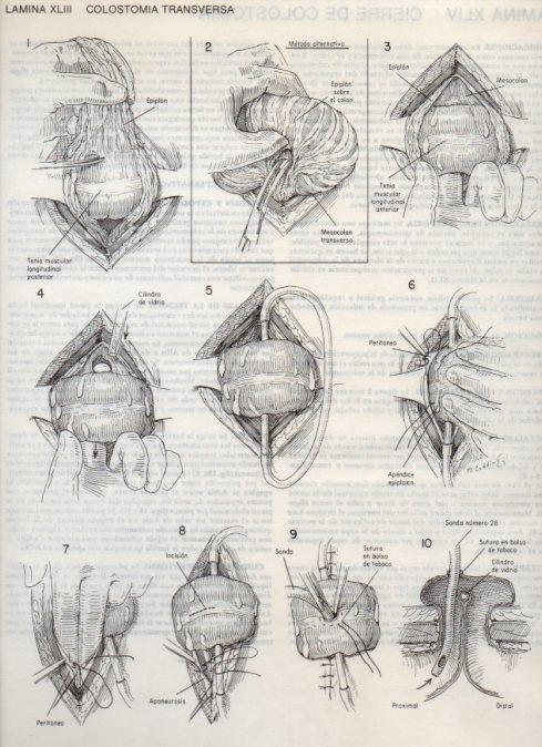 LAMINA V20104: Colostomia transversa