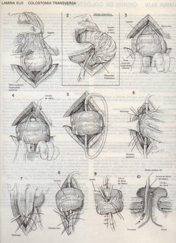 LAMINA V20104: Colostomia transversa