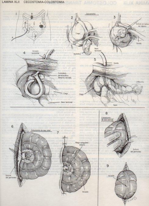 LAMINA V20103: Cecostomia-colostomia