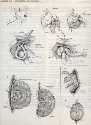 LAMINA V20103: Cecostomia-colostomia