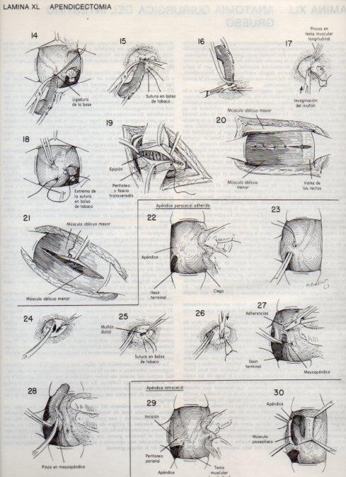 LAMINA V20101: Apendicectomia 1