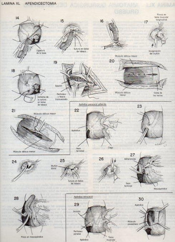 LAMINA V20101: Apendicectomia 1