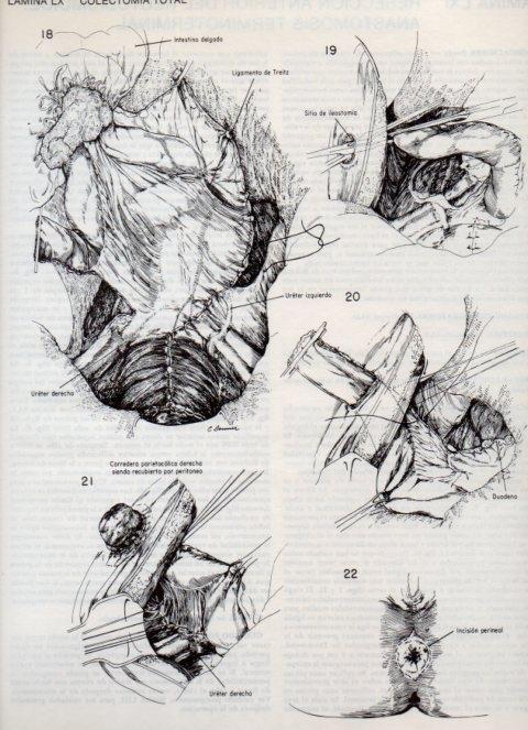 LAMINA V20121: Colectomia total