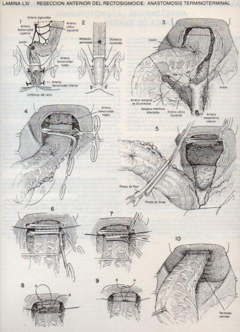 LAMINA V20122: Reseccion anterior del rectosigmoide: Anastomosis terminoterminal
