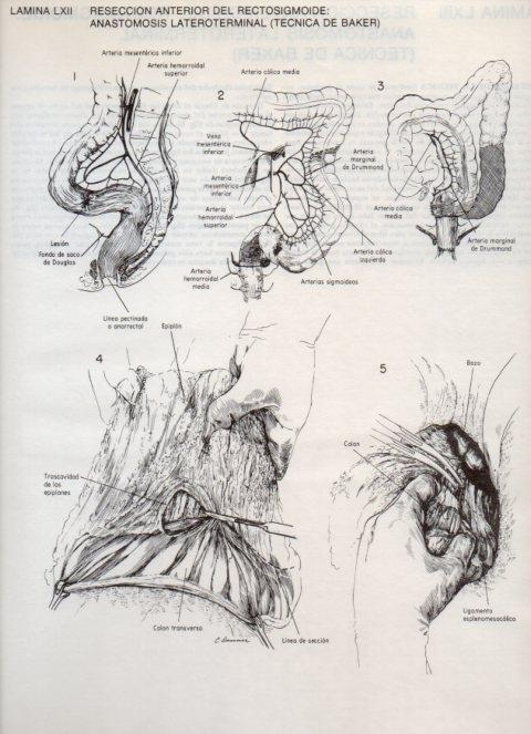LAMINA V20123: Reseccion anterior del rectosigmoide: Anastomosis lateroterminal (tecnica de Baker) 1