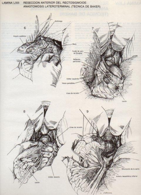 LAMINA V20124: Reseccion anterior del rectosigmoide: Anastomosis lateroterminal (tecnica de Baker) 2