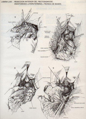 LAMINA V20124: Reseccion anterior del rectosigmoide: Anastomosis lateroterminal (tecnica de Baker) 2
