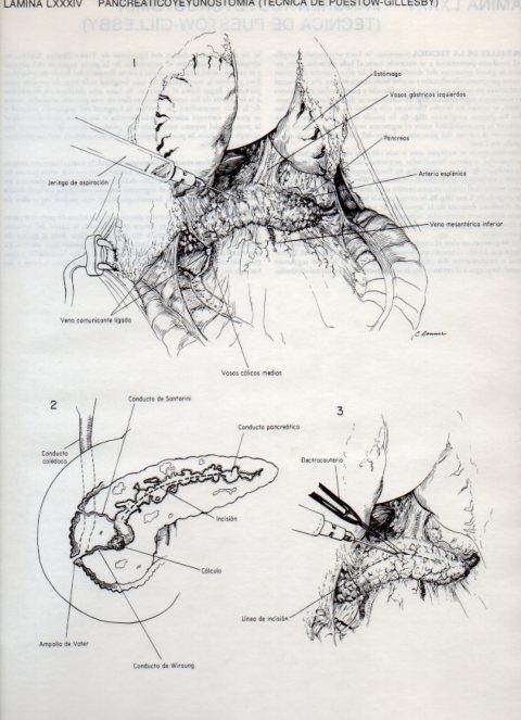LAMINA V20144: Pancreaticoyeyunostomia, tecnica de Puestow-Gillesby