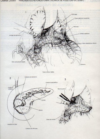 LAMINA V20144: Pancreaticoyeyunostomia, tecnica de Puestow-Gillesby