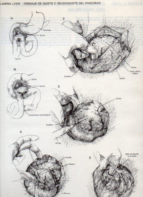 LAMINA V20142: Drenaje de quiste o seudoquiste del pancreas