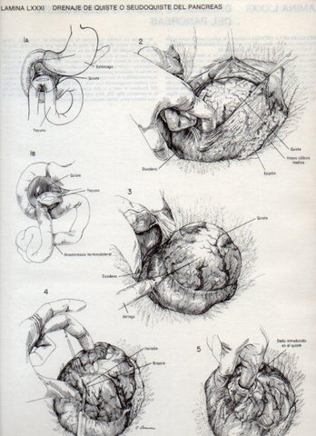 LAMINA V20142: Drenaje de quiste o seudoquiste del pancreas