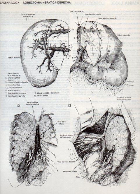 LAMINA V20140: Lobectomia hepatica derecha 2