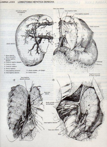 LAMINA V20140: Lobectomia hepatica derecha 2