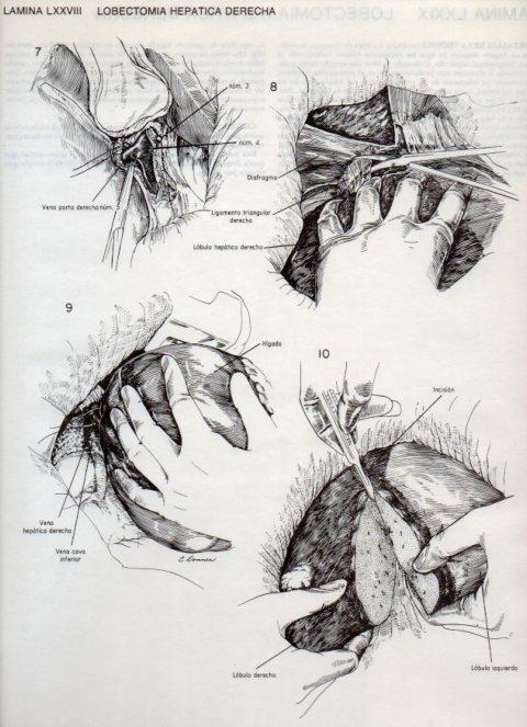 LAMINA V20139: Lobectomia hepatica derecha 1
