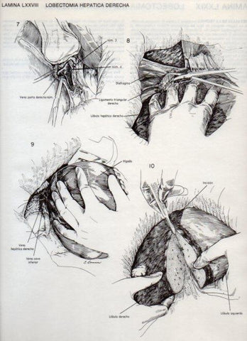 LAMINA V20139: Lobectomia hepatica derecha 1