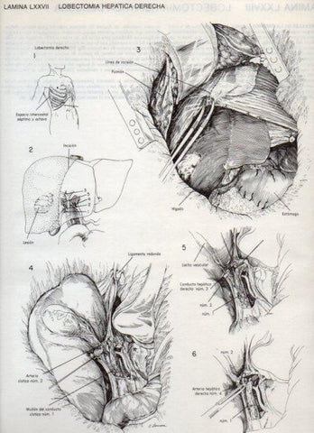 LAMINA V20138: Lobectomia hepatica derecha
