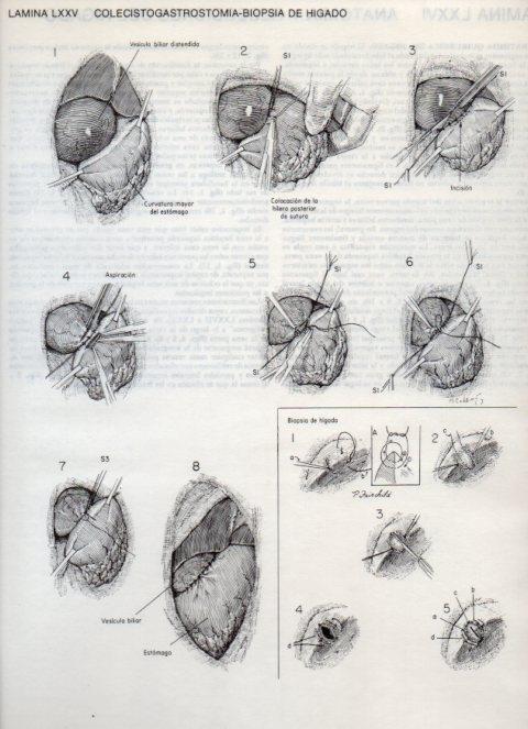 LAMINA V20136: Colecistogastrostomia-biopsia de higado