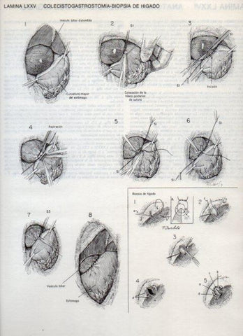 LAMINA V20136: Colecistogastrostomia-biopsia de higado
