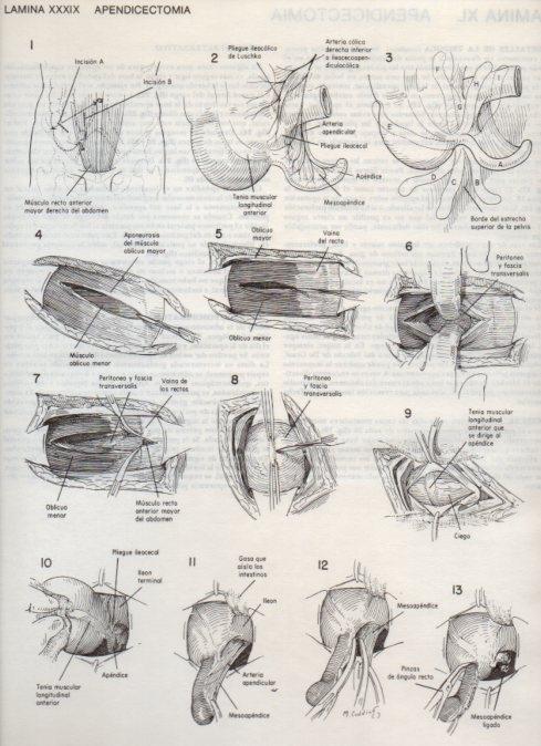 LAMINA V20100: Apendicectomia