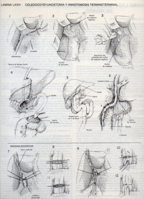 LAMINA V20135: Coledocoyeyunostomia y anastomosis terminoterminal